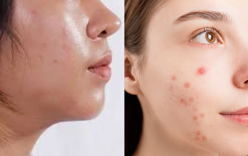 Can Acorn Oil Help With Acne-Prone Skin?